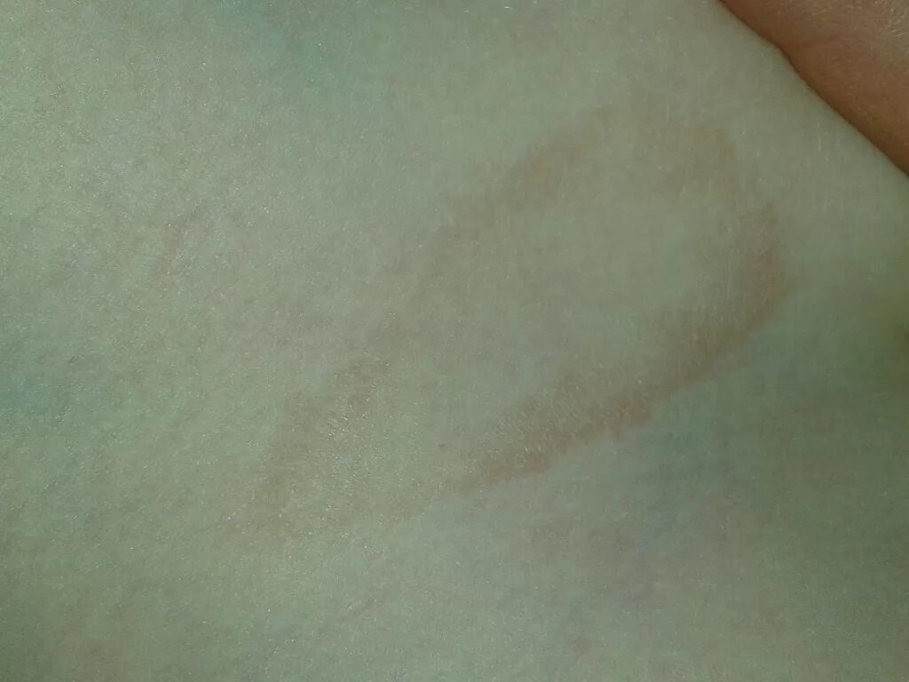 Край пятно. Кольцевидная эритема укус. Разноцветный лишай (Pityriasis versicolor). Склероатрофический Лихен. Отрубевидный лишай Видаля.