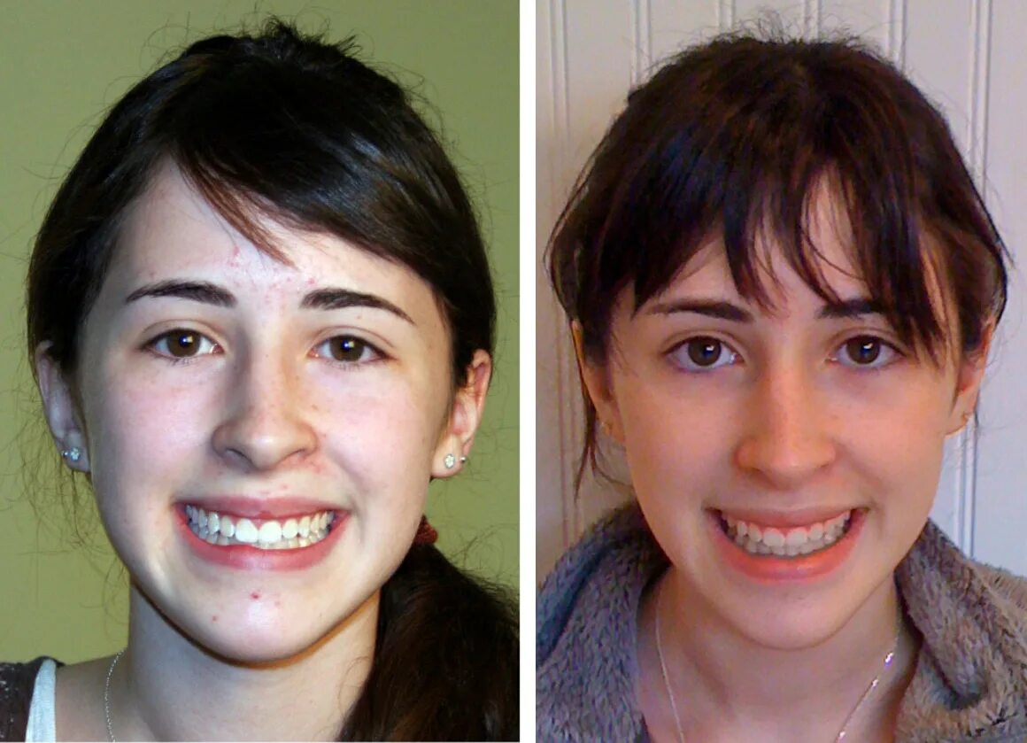 Асимметрия лица. Кривые зубы до и после брекетов. Изменения после брекетов