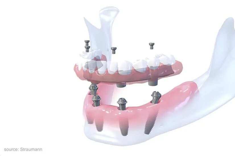 Имплантация зубов all on 4. Имплантация нижней челюсти. Верхний мост на 4х имплантах. Имплантация зубов верхней челюсти.