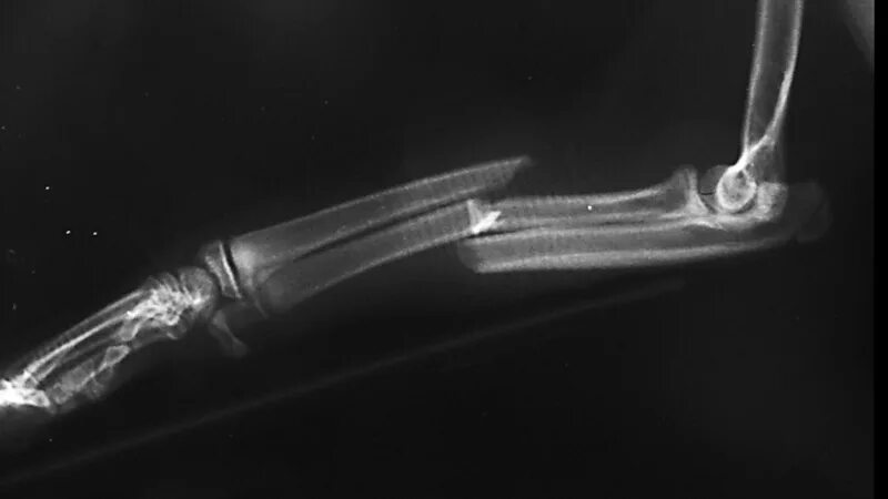 Оказани епервоц помощи. Перелом ости лопатки рентген. Сломанный случай. Несчастные случаи в туризме. Сломанный случай.