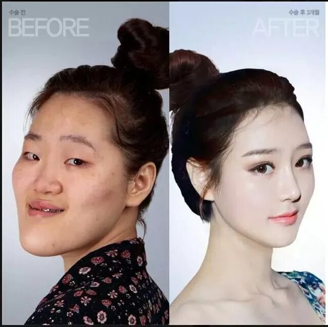 성형전 - Google Search Пластическая хирургия, Секреты красоты, Идеи макияжа