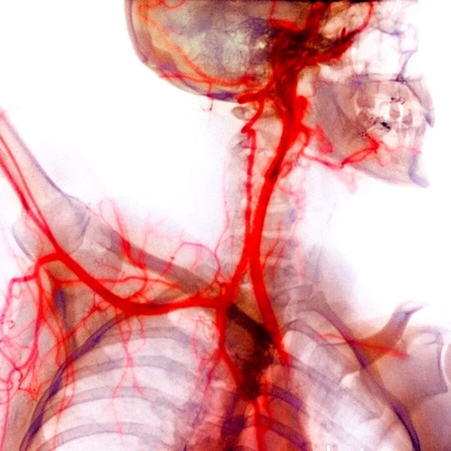 Нарушения кровеносных сосудов. Аневризма восходящего отдела аорты. Ангиограмма вен. Ангиография брахиоцефальных артерий анатомия.