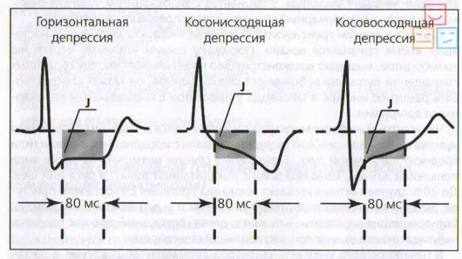 Депрессия сегмента st