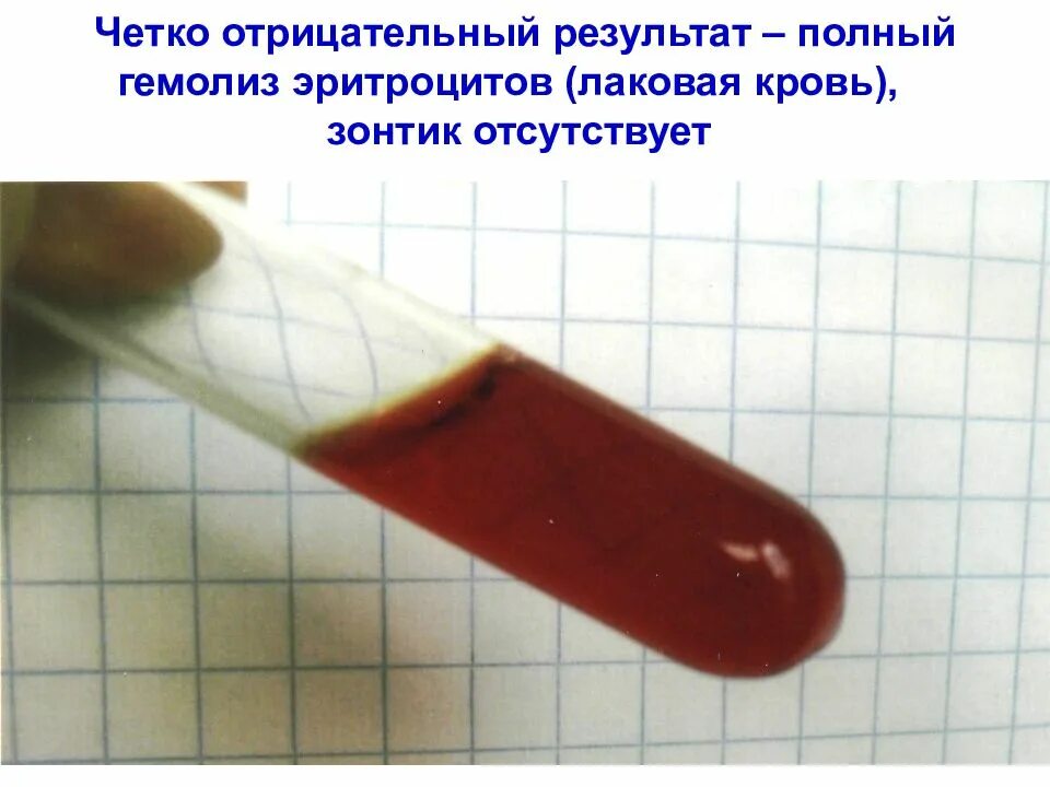Осадок эритроцитов. Гемолиз эритроцитов в пробирке. лаковая кровь.