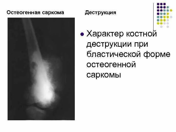 Виды сарком. Остеогенная остеолитическая саркома. Формы остеогенной саркомы. Остеогенная саркома локализация. Остеогенные саркомы рентгеносемиотика.