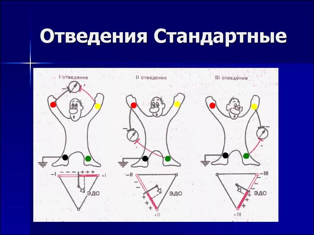 Три стандартных отведения ЭКГ. 1 Стандартное отведение ЭКГ. 3 Усиленных отведения ЭКГ. ЭКГ стандартные отведения на ЭКГ. Соп экг