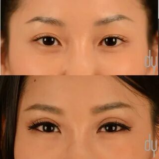 Asian Eyelid Surgery Asian Blepharoplasty.