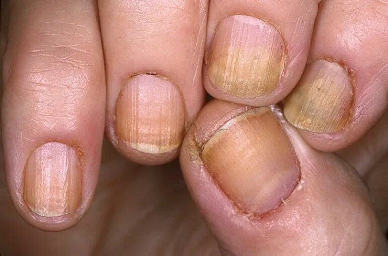 Почему ногти становятся тонкими. Ониходистрофия - онихолизис.. Микроспория онихолизис. Грибок ногтей онихолизис.