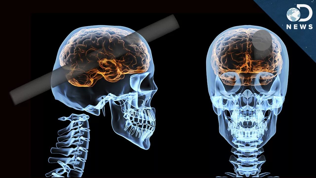 Brain 164. Головной мозг человека в черепе. Расположение мозга в черепной коробке.