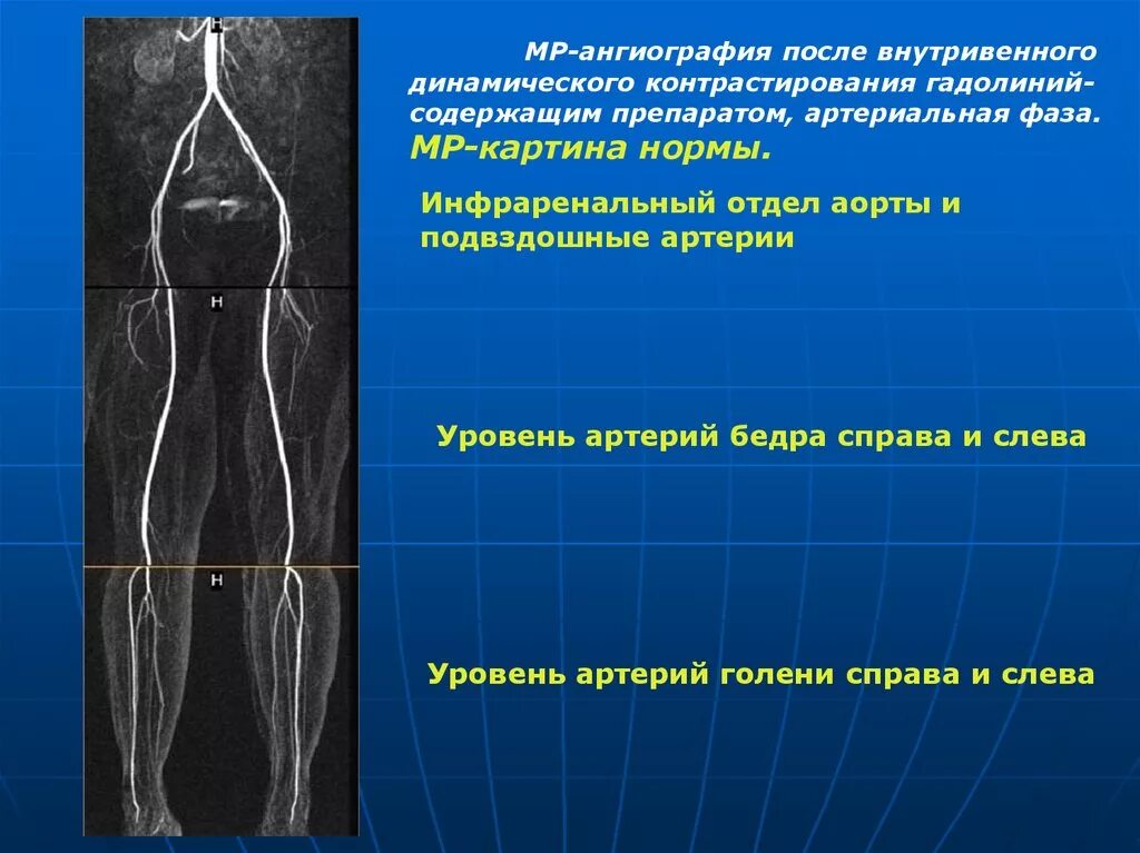 Аорты нижних конечностей. Ангиография подвздошных артерий. Ангиография бедренной артерии. Бедренная артерия рентген. МР ангиография сосудов нижних конечностей.