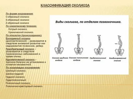 Сколиоз 8