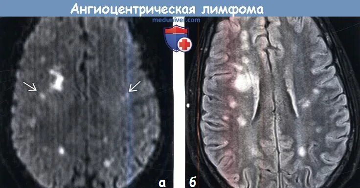 Очаг ограничения диффузии. Лимфома головного мозга на кт. лимфомы головного мозга на мрт. ограничение диффузии на мрт.