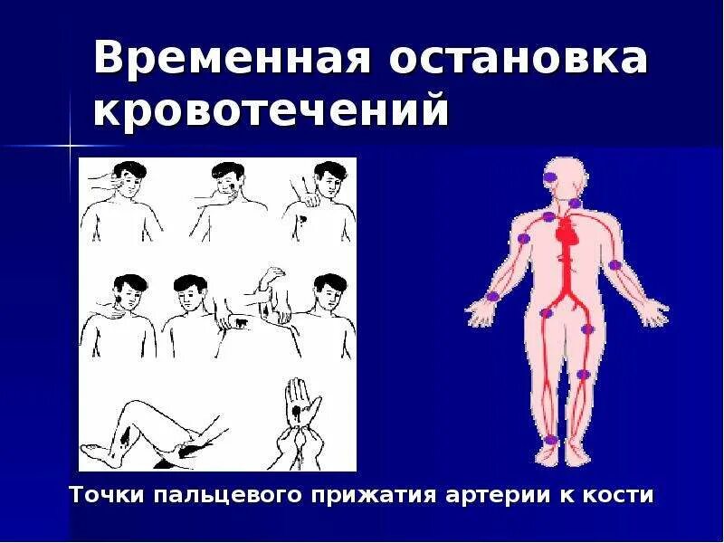 Пальцевое прижатие артерий осуществляется. Точки пальцевого прижатия кровотечения. точки прижатия для остановки кровотечения. остановка кровотечения пальцевое прижатие. кровотечение пальцевое прижатие артерии.