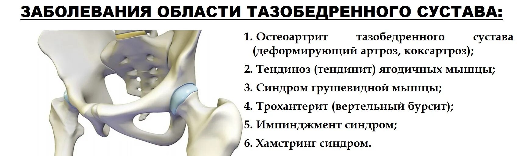 Тазобедренный отдает в поясницу. Тазобедренный сустав анатомия коксартроз. Тазобедренный сустав при коксартрозе. Коксартроз тазобедренного сустава стадии. Тазобедренный бандаж при коксартрозе тазобедренного.