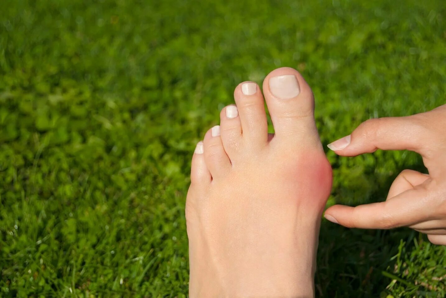 Пальцы на ногах картинки. Bunion hallux valgus. Вальгусная деформация стопы hallux valgus.