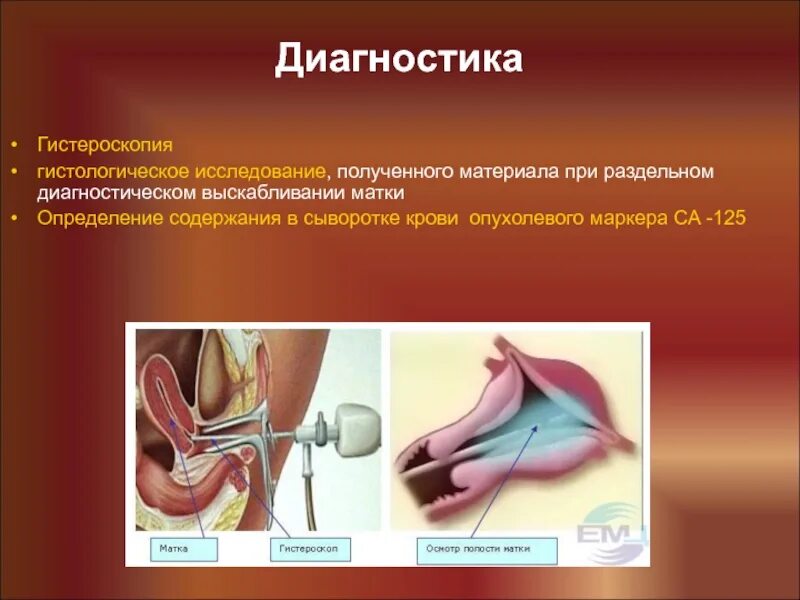 Рдв матки. Гистероскопия с раздельным выскабливанием. гистероскопическое исследование матки. гистероскопия диагноз.