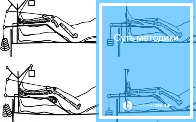 Скелетное вытяжение при переломе бедра. Скелетное вытяжение бедра техника. Скелетное вытяжение костей голени. Скелетное вытяжение 2023.