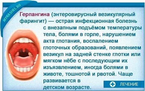 Герпесная ангина у ребенка лечение