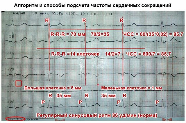 Как узнать сердцебиение. Подсчет ЧСС на ЭКГ. Формула подсчета ЧСС на ЭКГ. Подсчёт ЧСС по ЭКГ 50 мм. ЭКГ расшифровка ЧСС формула.