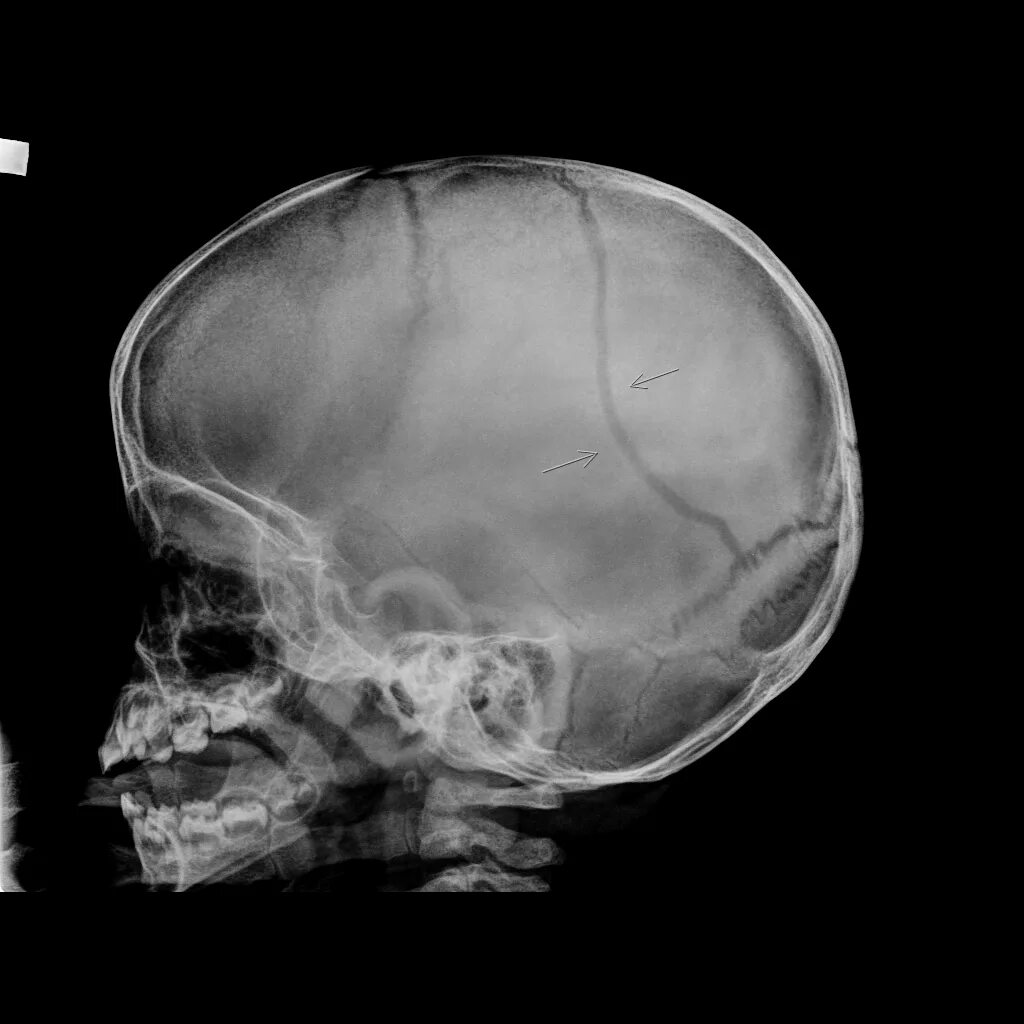 Трещина в голове. Перелом костей черепа рентген. Перелом затылочной кости рентген. Кости черепа рентген норма. Вдавленный перелом черепа рентген.