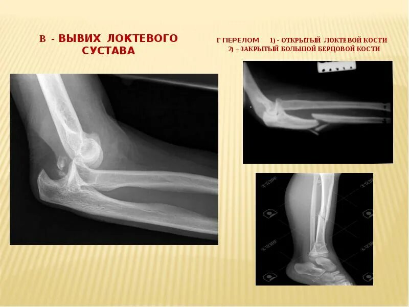 Вывих локтевого сустава. Подвывих локтевого сустава рентген. вывих локтевого сустава рентген. локтевой сустав рентген перелом локтевого.