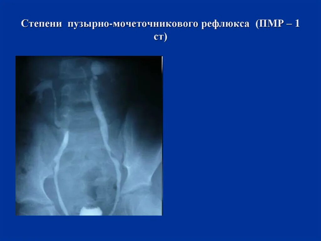 Рефлюкс 2 степени. Пузырно-мочеточниковый рефлюкс 1 степени рентген. Пузырно-мочеточниковый рефлюкс почка на УЗИ. Пузырно-мочеточниковый рефлюкс 2 степени. Пузырно-мочеточниковый рефлюкс степени рентген.