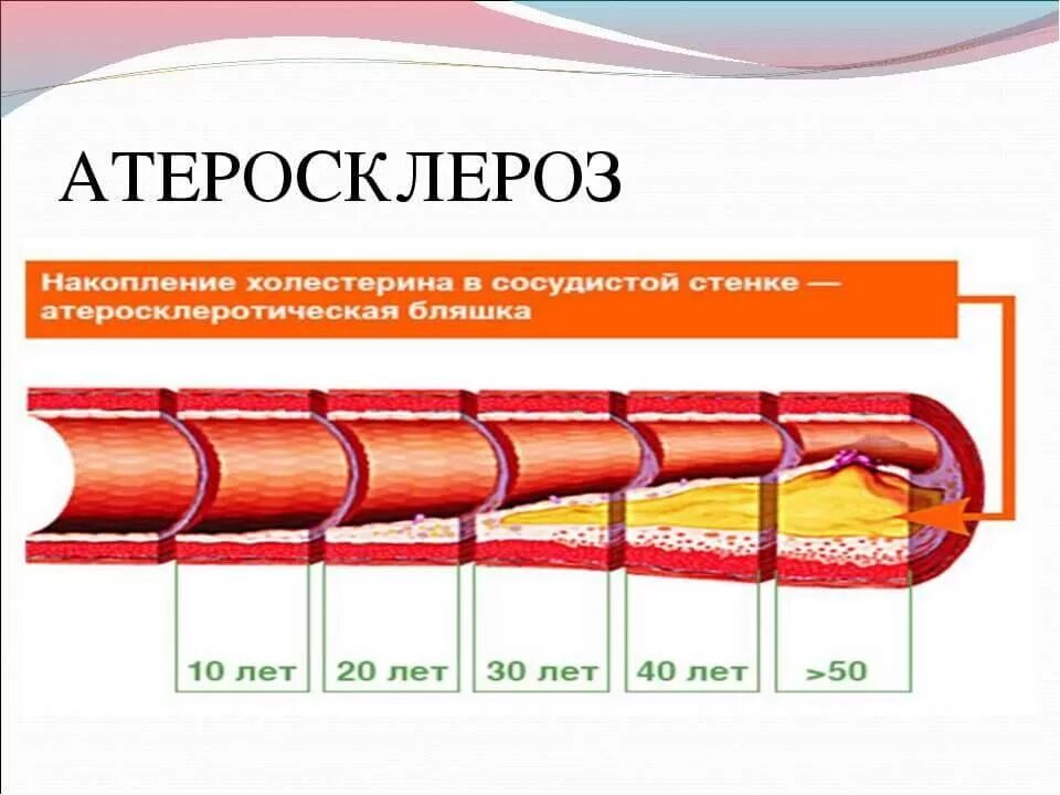 Признаки атеросклеротического поражения артерии. Aterokskleroz.