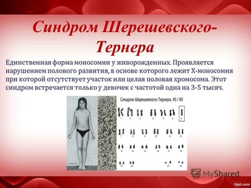 синдром шерешевского тернера трисомии клайнфельтера. шерешевского тернера синдром кариотип причины. синдром шерешевского тернера синдром клайнфельтера. шерешевского тернера хромосомы. синдром шерешевского клайнфельтера.