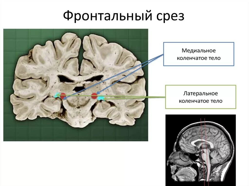 Фронтальный срез