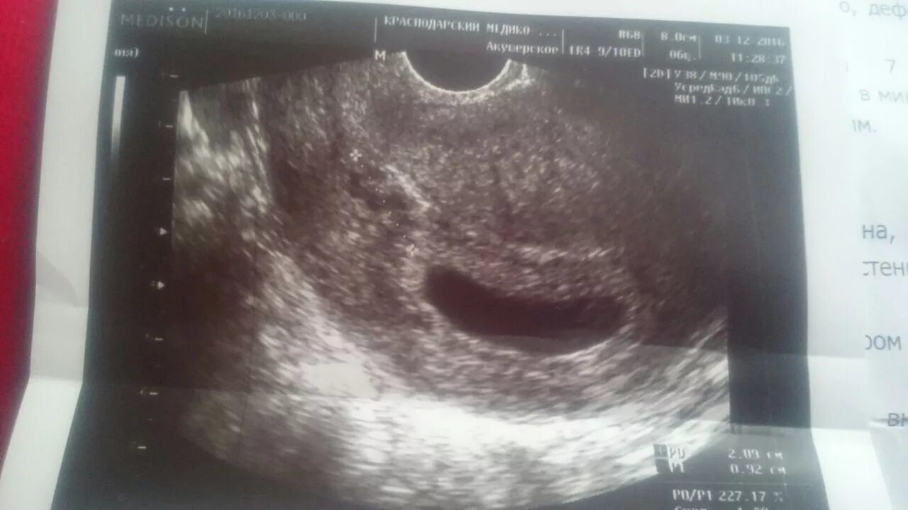 Темные ореолы при беременности. Ореолы беременности на ранних. Грудь беременных на ранних стадиях. Грудь при беременности на ранних сроках. Ореолы беременности на ранних.