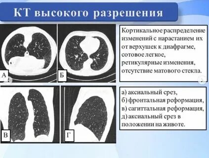 Фиброзные изменения верхних долей легких