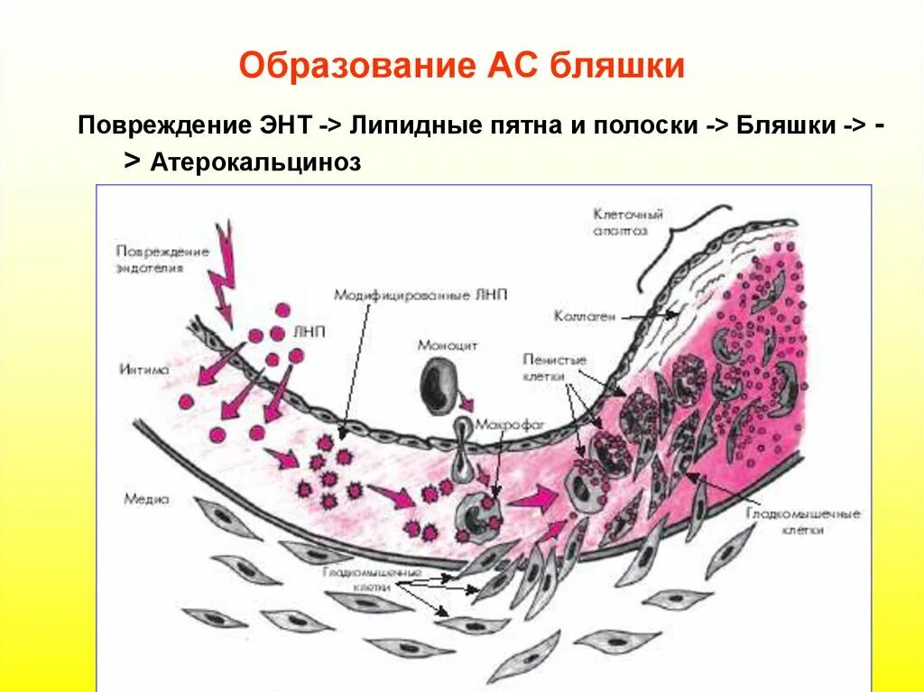 Образование атеросклеротической бляшки. Схема формирования атеросклеротической бляшки. образование атеросклеротической бляшки патогенез. патогенез атеросклероза схема. схема начальной стадии атерогенеза.