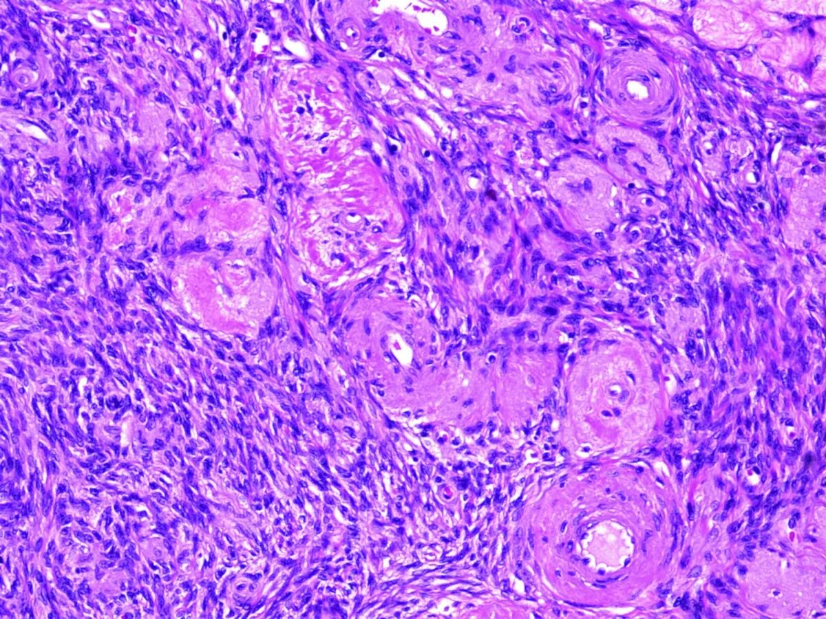Стромальная саркома. Саркома матки гистология. Эндометриальная стромальная саркома матки гистология. Стромальная саркома эндометрия гистология. Злокачественная олигодендроглиома гистология.