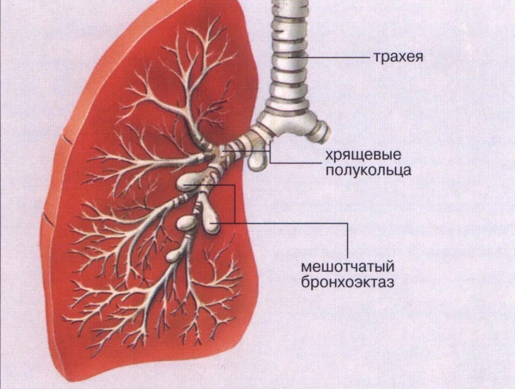Бронхоэктазия