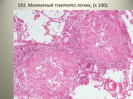 Милиарный туберкулез легких описание