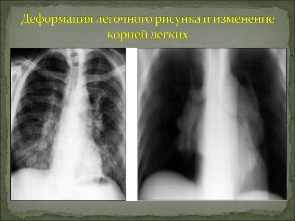 Легочный рисунок деформирован. Деформация легочного рисунка. Деформация легочного рисунка на рентгене. Что значит легкие расширены