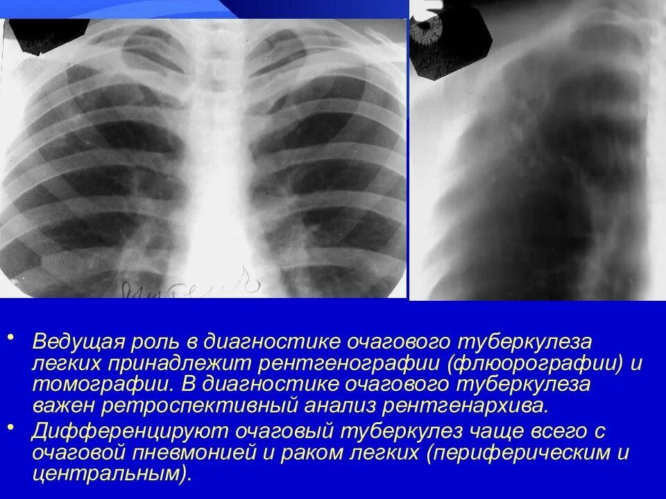 Очаговый туберкулез легкого рентген. Очаговый туберкулез рентген признаки. Очаговый туберкулез легких рентген. Очаговый туберкулез рентген. Очаговый туберкулез рентген признаки.