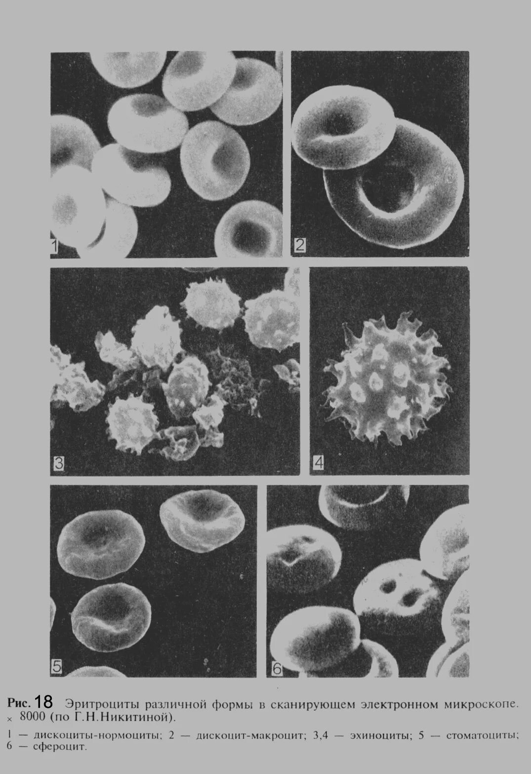 Эхиноциты эритроциты. Эритроциты различной формы в сканирующем электронном микроскопе. Эритроциты разной формы. Эритроцит электронный микроскоп. Эхиноциты