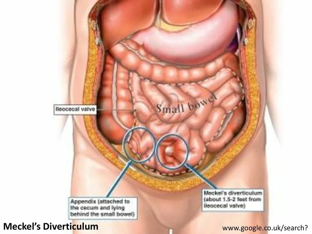 Где находится аппендикс у человека у женщины. Строение человека аппендицит. Расположение аппендицита.