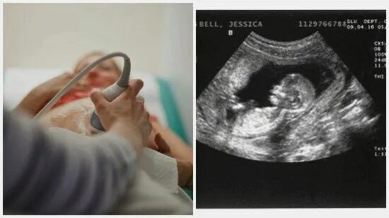Беременность 13 мм. УЗИ плода на 13 неделе беременности. УЗИ 13 акушерских недель. Как выглядит ребенок на УЗИ В 13 недель. Эмбрион на 13 неделе беременности УЗИ.