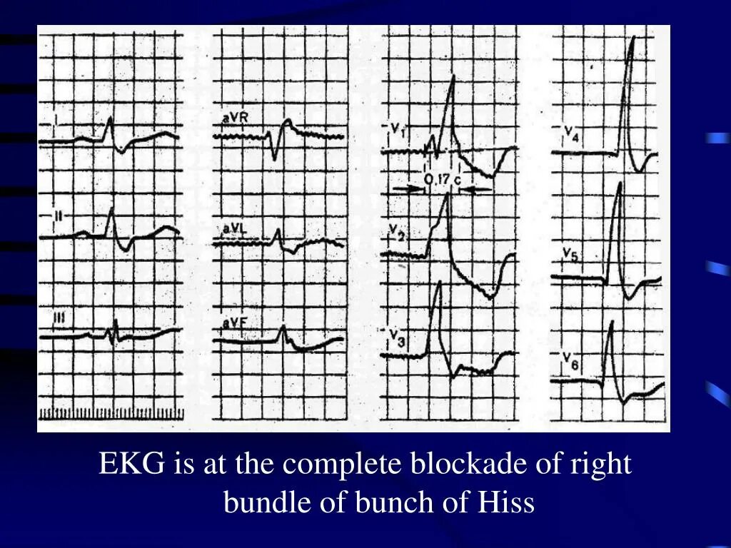 Блокада правой ножки пучка Гиса на ЭКГ. Блокада правого пучка Гиса на ЭКГ. ЭКГ при блокаде правой ножки пучка Гиса ЭКГ. Блокада ПНПГ на ЭКГ.