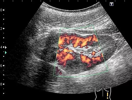 Абсцесс поджелудочной железы операция. Абсцесс поджелудочной железы кт. Парапанкреатический инфильтрат. Абсцесс панкреатита. Абсцесс панкреатита.