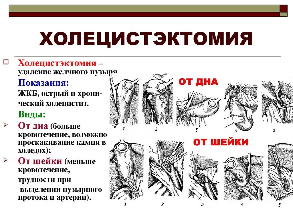 Холецистэктомия (показания, техника операции).. Этапы операции холецистэктомии ( от шейки). Холецистэктомия от дна этапы операции. Холецистэктомия от дна и от шейки. Этапы холецистэктомии