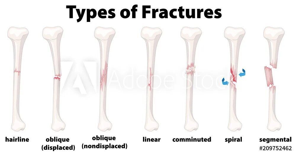 The fracture can be. The fracture can be