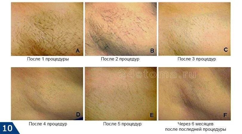 Лазерная эпиляция волосы выпадают через. Лазерная эпиляция. глубокая депиляция зоны бикини. лазерная эпиляция бикини.