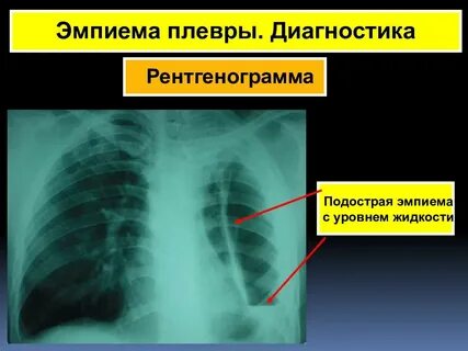 Эмпиема это