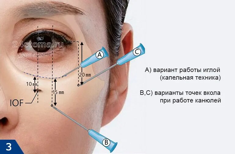 Как исправить точку процедуры