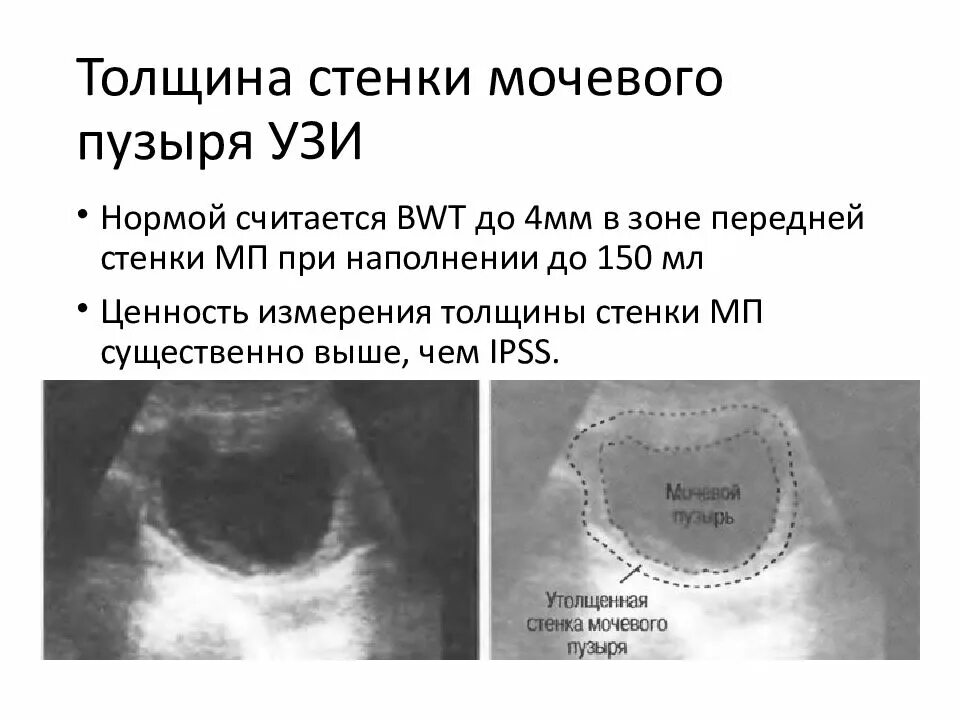 Толщина стенки мочевого пузыря УЗИ. Толщина стенки мочевого пузыря в норме на УЗИ. Толщина стенки мочевого пузыря при УЗИ. Образование в стенке мочевого пузыря на УЗИ.