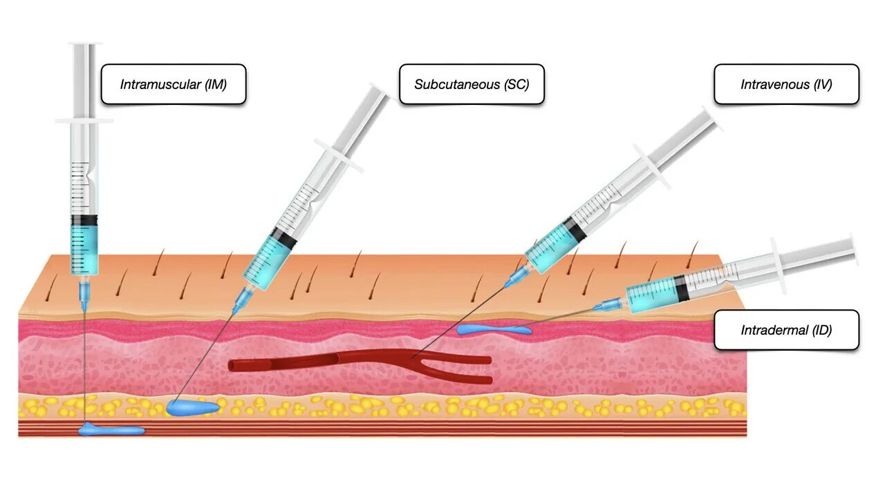 Inject mock. Types of injections. диаграмма инъекций. процесс закачивания краски в подкожный слой. four types of injection.