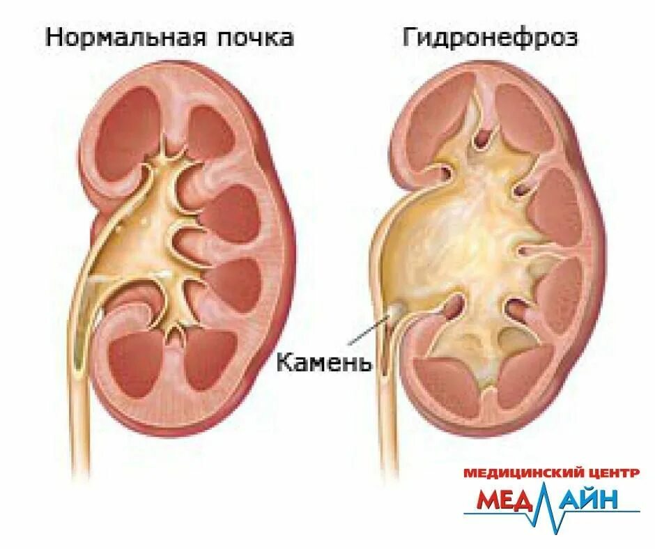 Камни почки и гидронефроз. Почечная лоханка колика. Расширение лоханки гидронефроз.